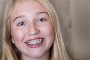 braces for kids