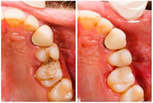 composite fillings