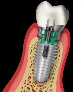 implant