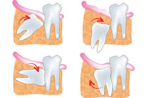 wisdom-teeth